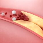 dieta care curata arterele de colesterolul in exces face curatenie in vasele de sange 69284cfc0010e